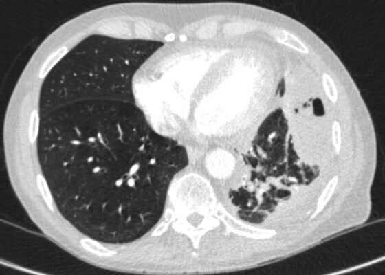 Case Report of an Empyema Identified on Lung Ultrasound 6 Creative Commons images
