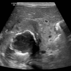 A Case Report of Neonatal Vomiting due to Adrenal Hemorrhage, Abscess and Pseudohypoaldosteronism 9 Creative Commons images