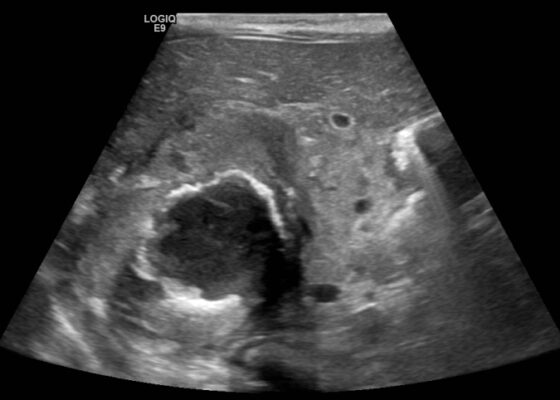 A Case Report of Neonatal Vomiting due to Adrenal Hemorrhage, Abscess and Pseudohypoaldosteronism 2 Creative Commons images