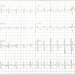 Case Report—Pediatric Brugada Phenotype from Accident Cocaine Ingestion 4 Creative Commons images