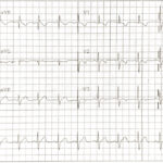Case Report—Pediatric Brugada Phenotype from Accident Cocaine Ingestion 3 Creative Commons images