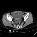 An Atraumatic, Idiopathic Case Report of Intraperitoneal Bladder Dome Rupture 1 Creative Commons images