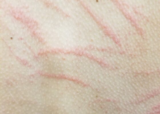 A Culinary Misadventure: A Case Report of Shiitake Dermatitis 4 Creative Commons images
