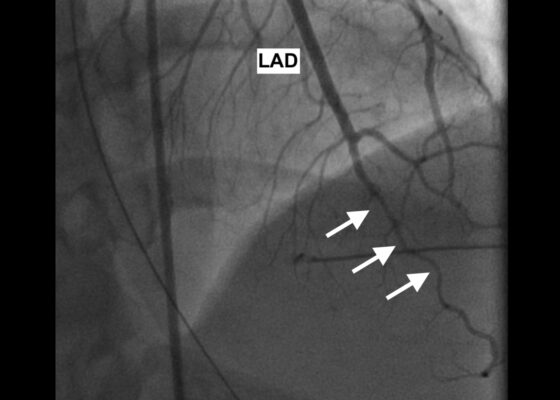 Spontaneous Coronary Artery Dissection Causing Cardiac Arrest in a Post-Partum Patient – A Case Report 2 Creative Commons images