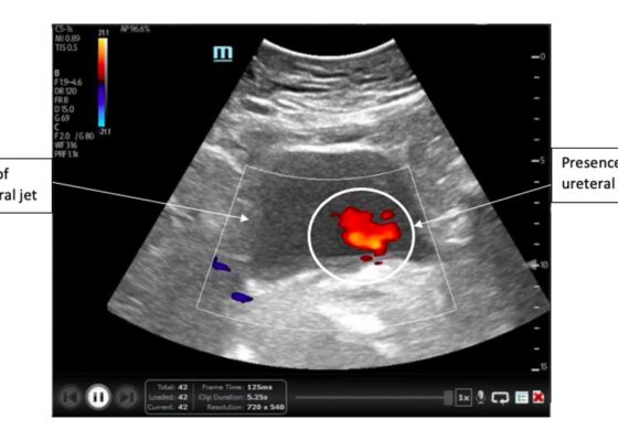 Ureteral Obstruction and Ureteral Jet Identification—A Case Report 8 Creative Commons images