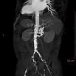 Initial Management and Recognition of Aortoiliac Occlusive Disease, A Case Report 3 Creative Commons images