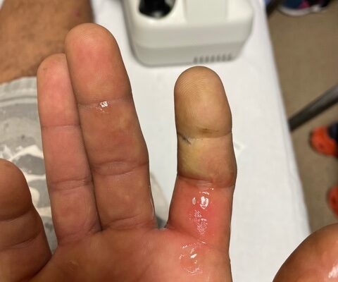 A Case Report of the Rapid Evaluation of a High-Pressure Injection Injury of a Finger Leading to Positive Outcomes 6 Creative Commons images