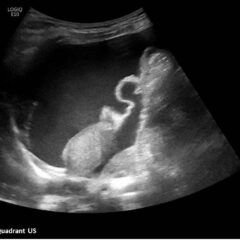 Ovarian Juvenile Granulosa Cell Tumor Case Report 4 Creative Commons images