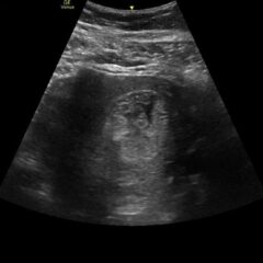 Point-of-Care Ultrasound to Diagnose Molar Pregnancy: A Case Report 3 Creative Commons images