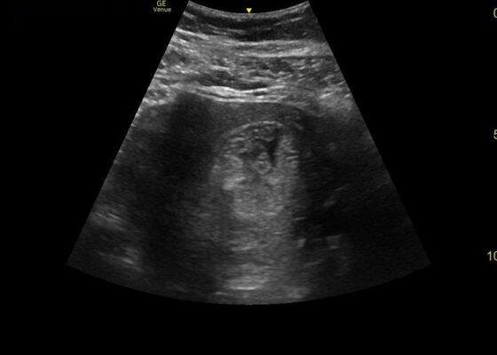 Point-of-Care Ultrasound to Diagnose Molar Pregnancy: A Case Report 2 Creative Commons images