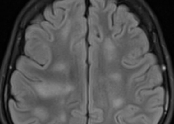 Clinical and Radiologic Features of Fulminant Pediatric Autoimmune Encephalitis: A Case Report 2 Creative Commons images