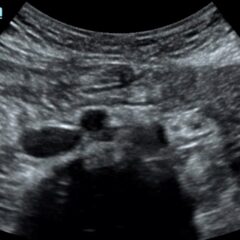 A Case Report of May-Thurner Syndrome Identified on Abdominal Ultrasound 2 Creative Commons images