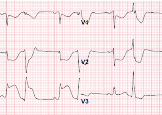 Inferior STEMI Electrocardiogram in a Young Postpartum Female with Sickle Cell Trait with Chest Pain - A Case Report 4 Creative Commons images