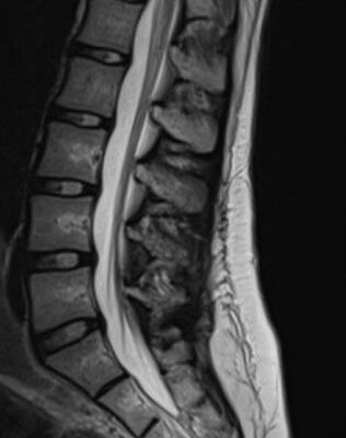 Transverse Myelitis in Naloxone Reversible Acute Respiratory Failure—A Case Report 6 Creative Commons images