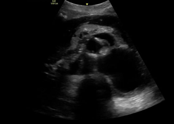 Aortic Dissection Case Report 4 Creative Commons images