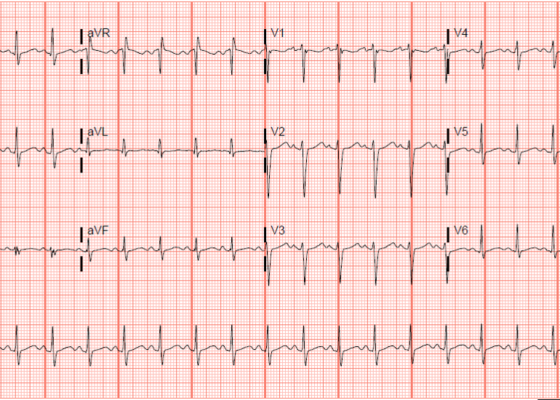Electrocardiogram Abnormalities Following Diphenhydramine Ingestion: A Case Report 6 Creative Commons images
