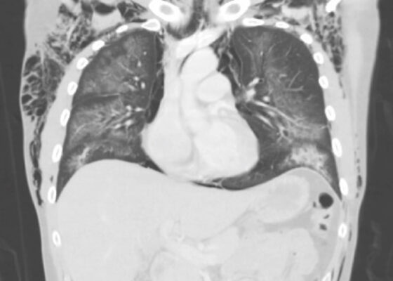 Electronic Cigarette or Vaping-Associated Lung Injury Case Report 6 Creative Commons images