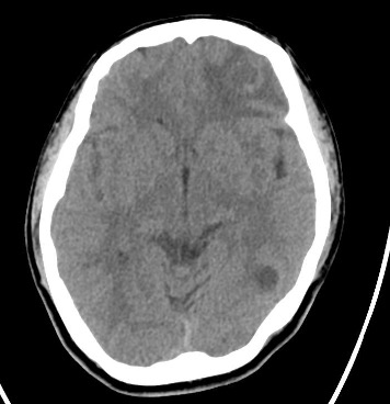 Epilepsy Caused by Neurocysticercosis: A Case Report 2 Creative Commons images