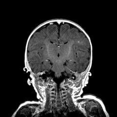 A Case of Community-Acquired Tuberculosis in an Infant Presenting with Pneumonia Refractory to Antibiotic Therapy 7 Creative Commons images