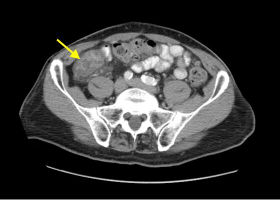 Imaging Findings of Small Bowel - Diverticulitis: A Case Report 2 Creative Commons images