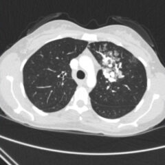 Pulmonary Arteriovenous Malformation in a Patient with Suspected Hereditary Hemorrhagic Telangiectasia: A Case Report 6 Creative Commons images