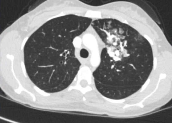 Pulmonary Arteriovenous Malformation in a Patient with Suspected Hereditary Hemorrhagic Telangiectasia: A Case Report 10 Creative Commons images