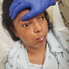 A Case Report of Invasive Mucormycosis in a COVID-19 Positive and Newly-Diagnosed Diabetic Patient 7 Mucormycosis. Photograph 2. JETem 2023