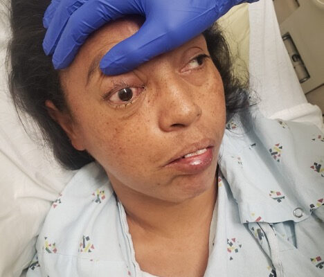 A Case Report of Invasive Mucormycosis in a COVID-19 Positive and Newly-Diagnosed Diabetic Patient 4 Mucormycosis. Photograph 2. JETem 2023