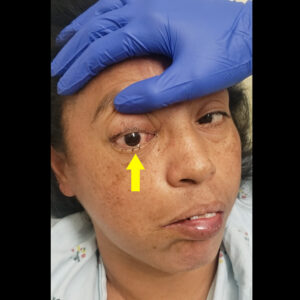 Mucormycosis. Photograph 3. Annotated. JETem 2023