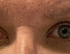 Internuclear Ophthalmoplegia. Eyes Right Unannotated. JETem 2024