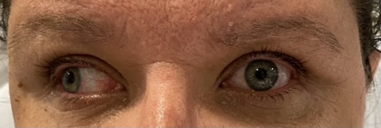 Internuclear Ophthalmoplegia. Eyes Right Unannotated. JETem 2024