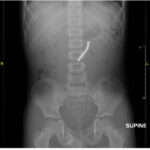 Point-Of-Care Ultrasound Use for Detection of Multiple Metallic Foreign Body Ingestion in the Pediatric Emergency Department: A Case Report 1 Point Of Care Ultrasound Use for Detection of Multiple Metallic Foreign Body Ingestion. KUB. JETem 2023