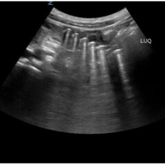 Point-Of-Care Ultrasound Use for Detection of Multiple Metallic Foreign Body Ingestion in the Pediatric Emergency Department: A Case Report 9 Point Of Care Ultrasound Use for Detection of Multiple Metallic Foreign Body Ingestion. US. JETem 2023