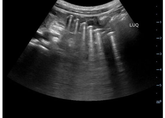 Point-Of-Care Ultrasound Use for Detection of Multiple Metallic Foreign Body Ingestion in the Pediatric Emergency Department: A Case Report 10 Point Of Care Ultrasound Use for Detection of Multiple Metallic Foreign Body Ingestion. US. JETem 2023