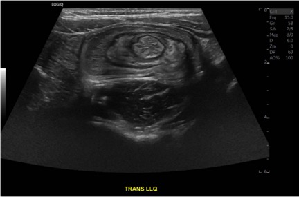 Colocolic Intussusception. Abdominal Ultrasound Unannotated. JETem 2024