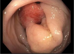 Colocolic Intussusception. Colonoscopy Unannotated. JETem 2024