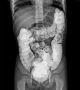 Colocolic Intussusception. Contrast Enema. JETem 2024