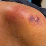 Septic Arthritis of AC Joint. Shoulder Photo Close. JETem 2024