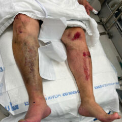 A Case Report of Acute Compartment Syndrome 7 Acute Compartment Syndrome. Photo Pre Fasciotomy. JETem 2024