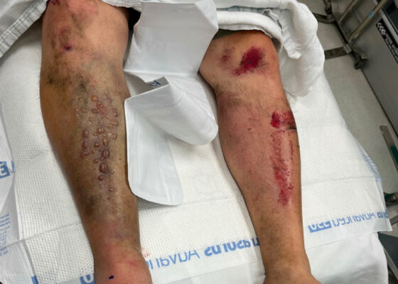 Acute Compartment Syndrome. Photo Pre Fasciotomy. JETem 2024