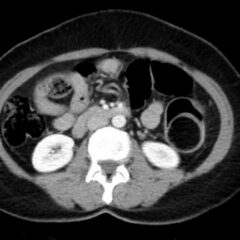 Telescoping into Adulthood: A Case Report of Intussusception in an Adult Patient 4 Adult Intussusception. CT Axial Unannotated. JETem 2024