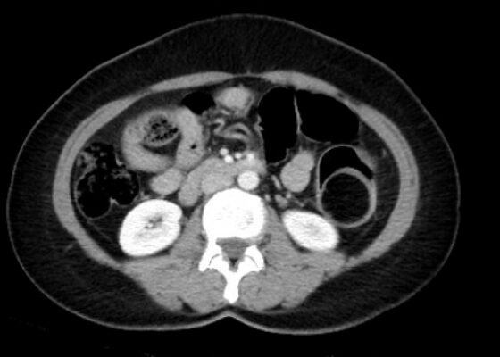 Telescoping into Adulthood: A Case Report of Intussusception in an Adult Patient 6 Adult Intussusception. CT Axial Unannotated. JETem 2024