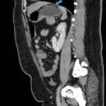 A Case Report Evaluating Gastric Emphysema versus Emphysematous Gastritis 3 Gastric Emphysema. Sagital CT annotated. JETem 2024