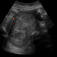 Vaginal Bleeding Due to Iatrogenic Uterine Perforation – A Case Report 6 Iatrogenic Uterine Perforation. US Unannotated. JETem 2024