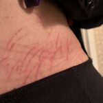 A Case Report of Dermatographia 1 Dematographia
