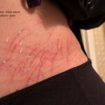 A Case Report of Dermatographia 2 Dermatographia annotated. JETem 2024