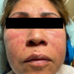A Case Report on Dermatomyositis in a Female Patient with Facial Rash and Swelling 7 Dermatomyositis Face. JETem 2024