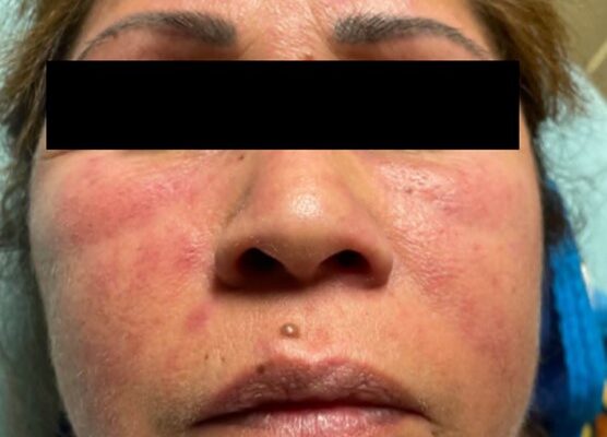 Dermatomyositis Face. JETem 2024