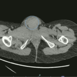 Computed Tomography Findings in Non-Obstetric Vulvar Hematoma: A Case Report 2 Vulvar Hematoma. CT Axial Annotated. JETem 2024