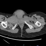 Computed Tomography Findings in Non-Obstetric Vulvar Hematoma: A Case Report 1 Vulvar Hematoma. CT Axial Unannotated. JETem 2024